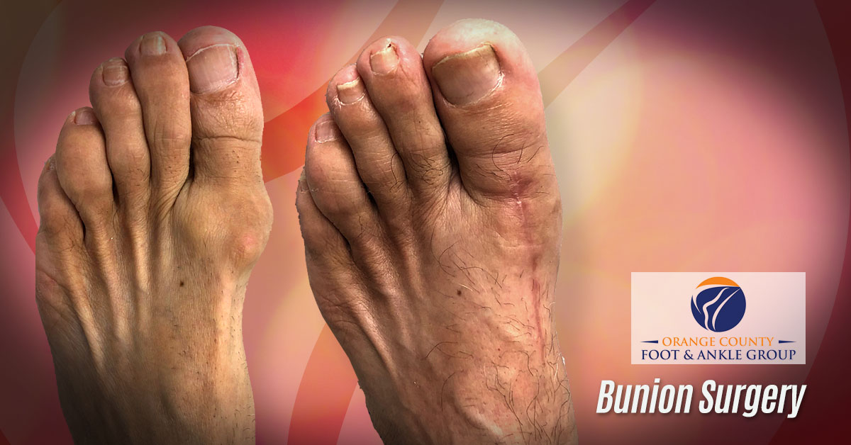 Bunion Treatment