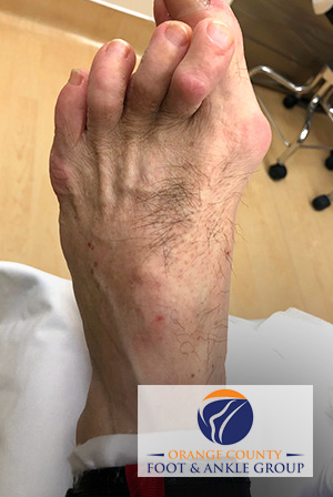 Custom orthotics for bunions