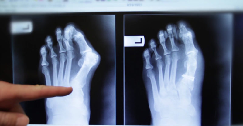 Examining a bunion